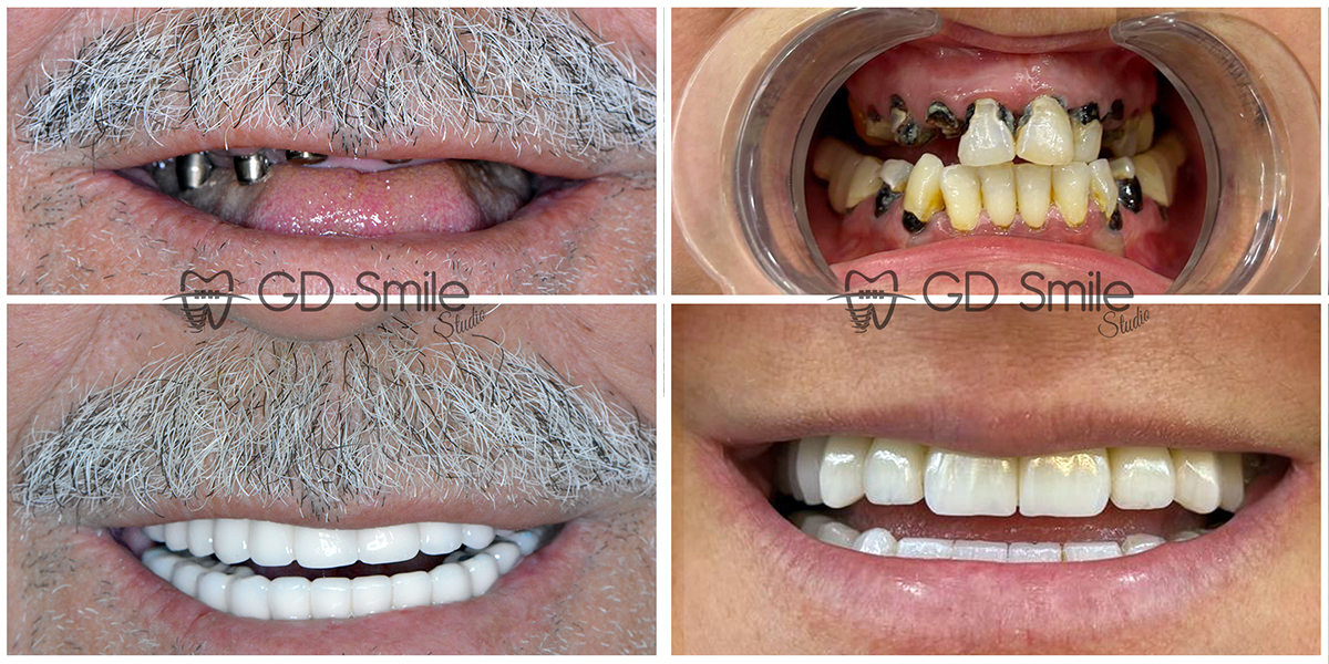 Before and After Dental Transformations