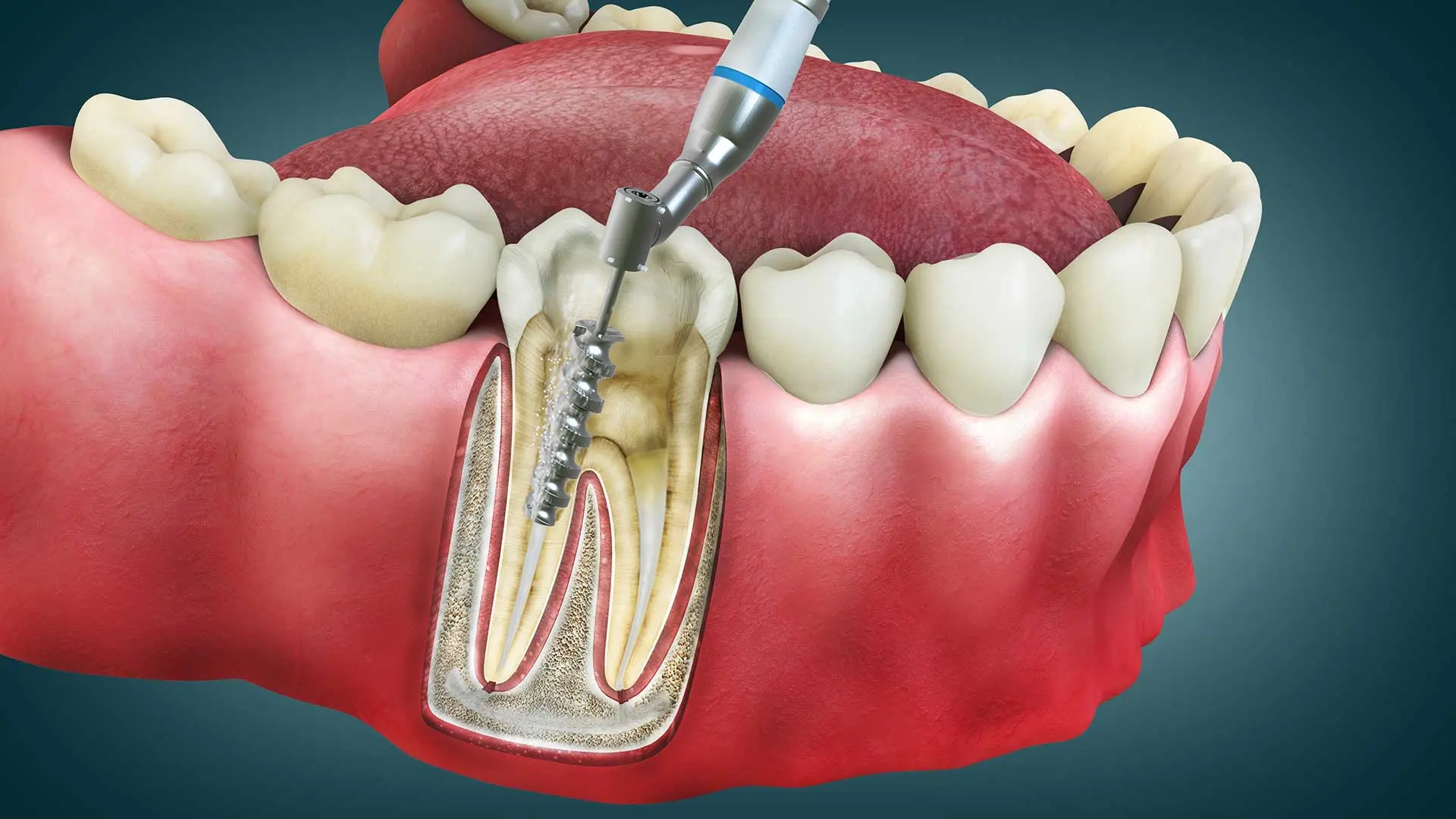 How to Recognize a Failed Root Canal Treatment?