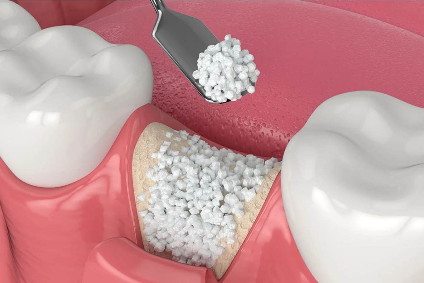 Is Bone Grafting for Dental Implants Really Safe? Expert Insights and Full Details