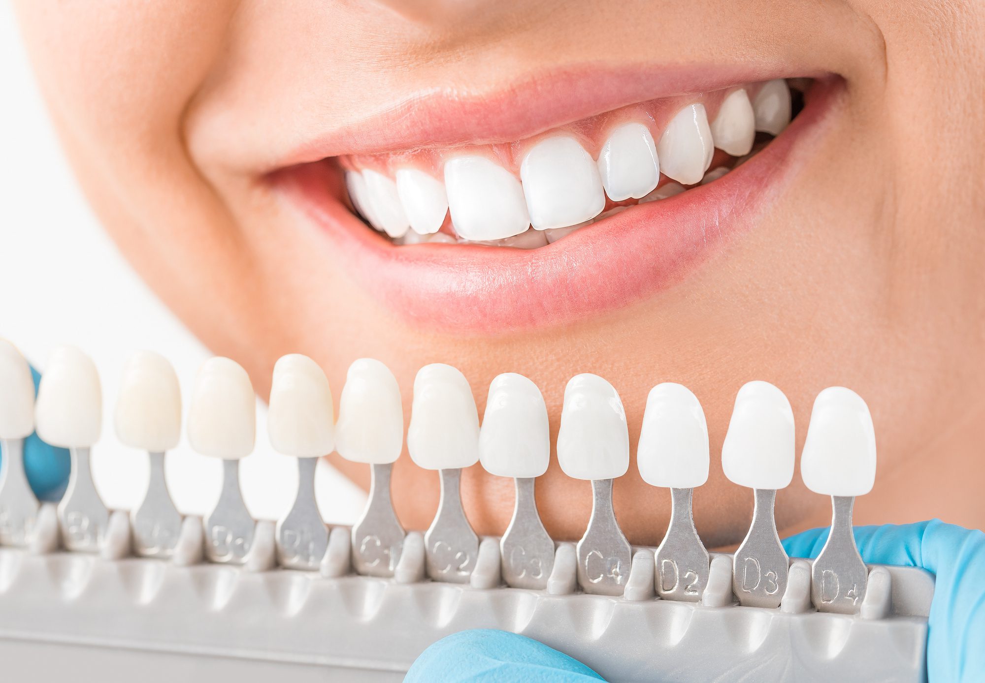 Best Place to Get Dental Crowns in Turkey | GD Smile Studio 2025–2026 Guide