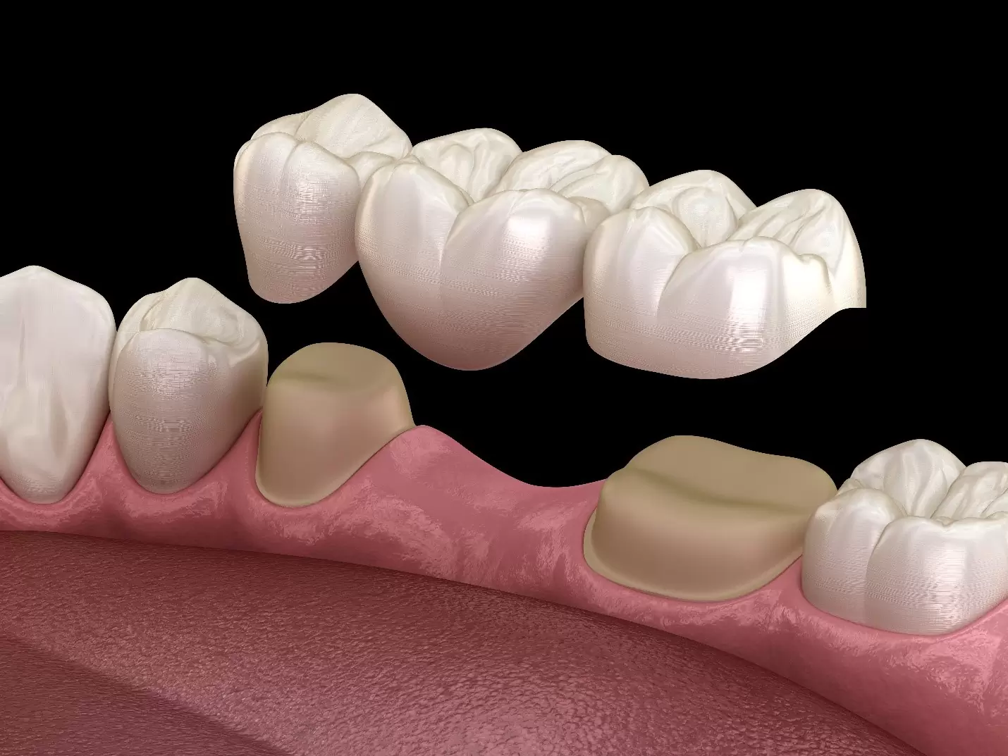 What Is a Dental Bridge? Types, Benefits, and Procedure
