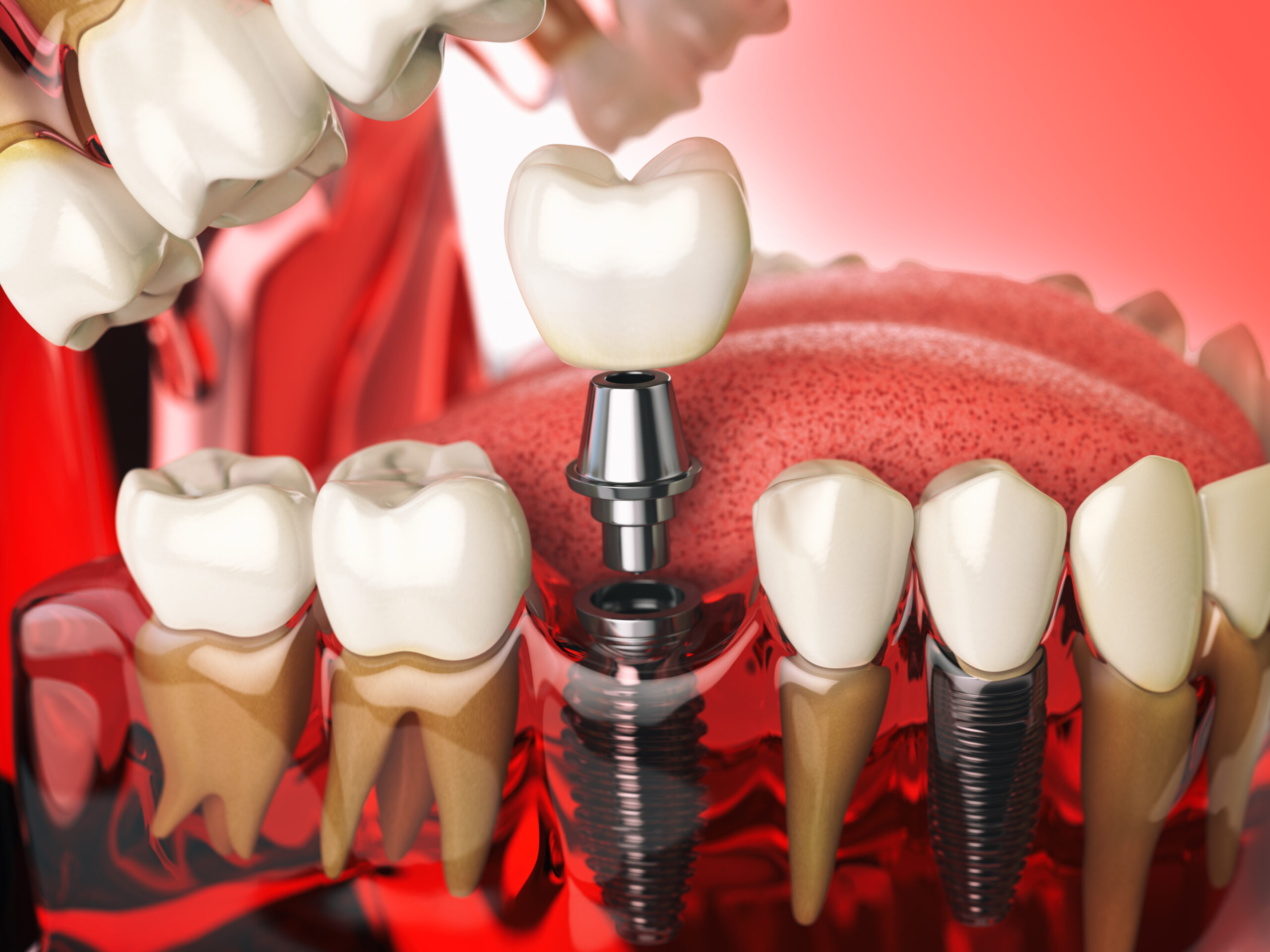 10 Shocking Dental Implant Facts You’ve Never Heard Before