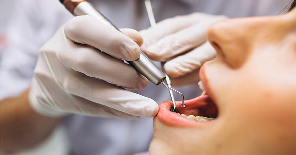 What to Do After Tooth Reduction: Essential After‑Care Tips
