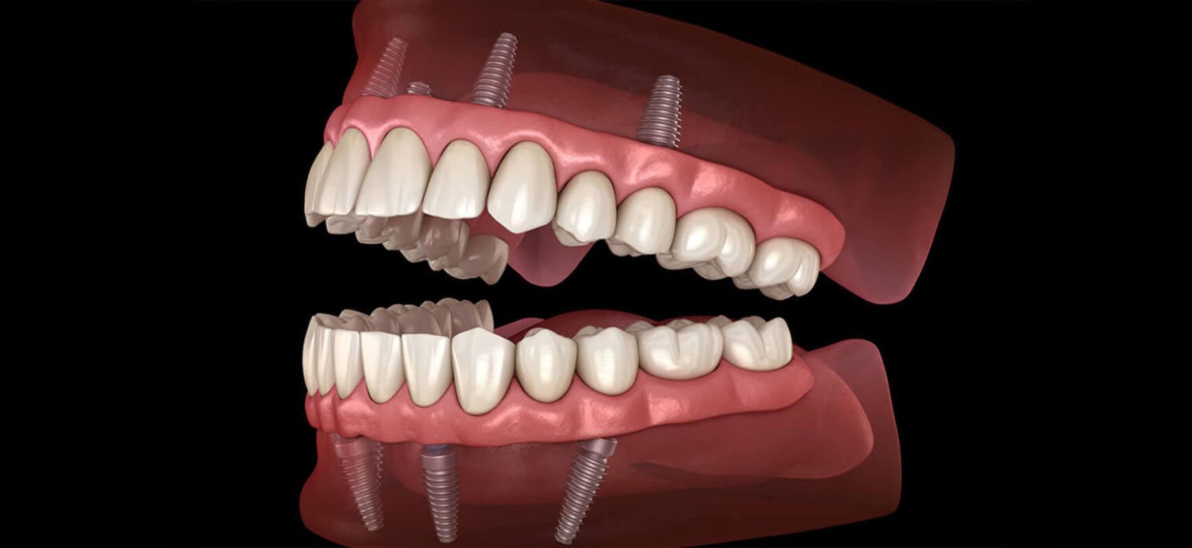 Same-Day Full-Mouth Dental Implants in Turkey: How Long Does It Take? A Health Tourism Guide