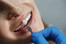 Veneers Without Tooth Shaving in Turkey: 2025-2026 Guide