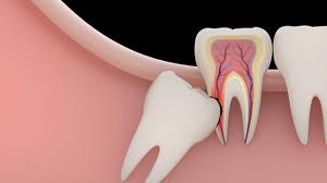 Wisdom Tooth Extraction in Turkey 2025-2026 – Costs, Sedation, Healing & Travel Suitability