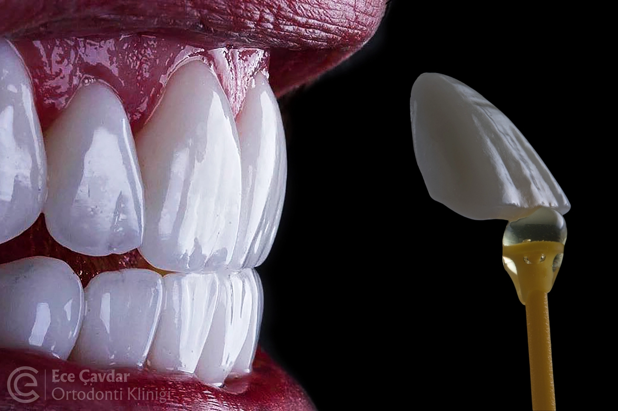 Veneer Treatments: Why Are They a Top Choice in Turkey?