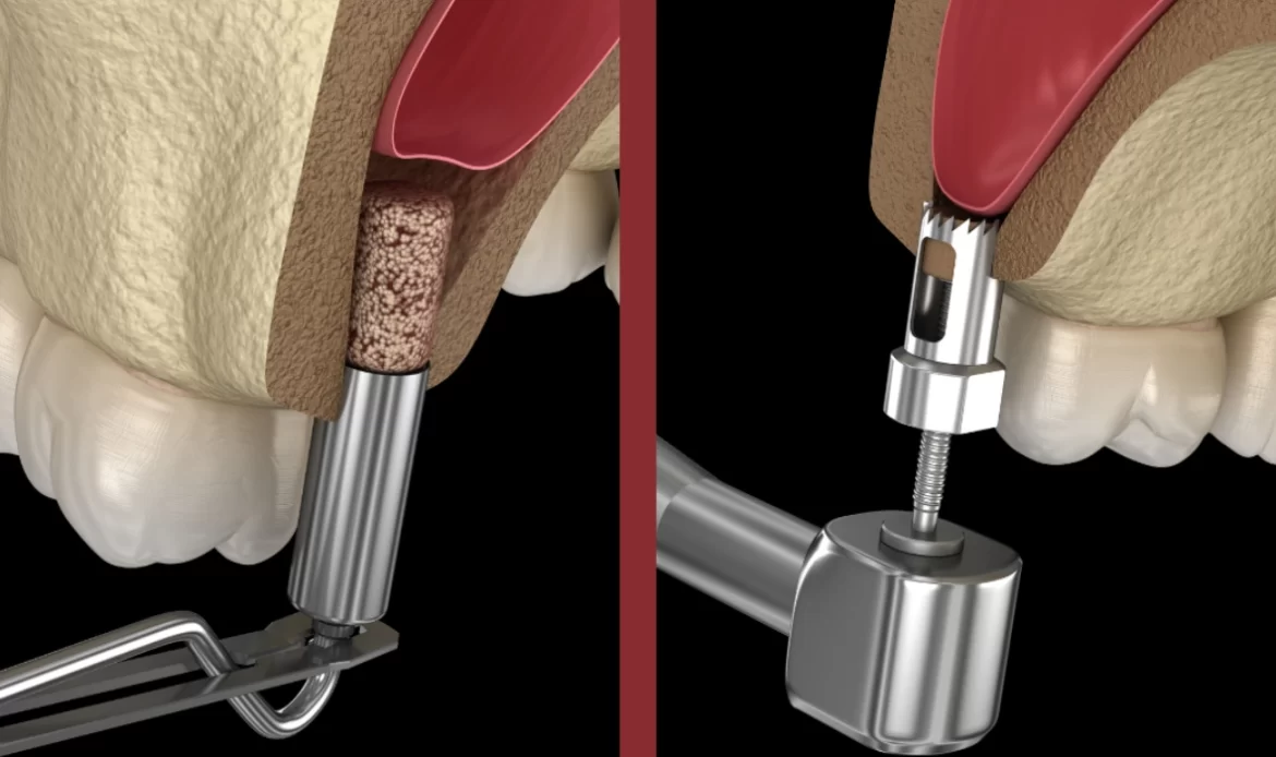 Dental Implants and Sinus Lifts: Who Needs Them?