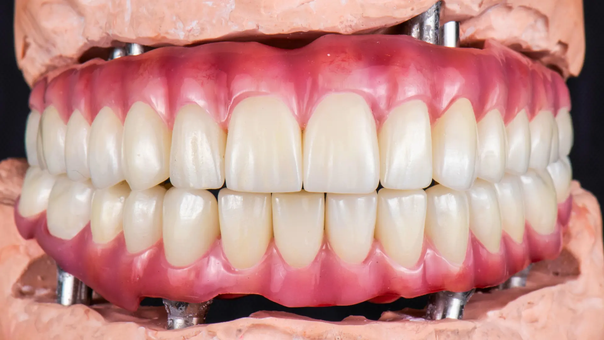 Full Mouth Dental Implant Cost in Turkey: What to Expect and How Long Is the Recovery? | GD Smile Studio