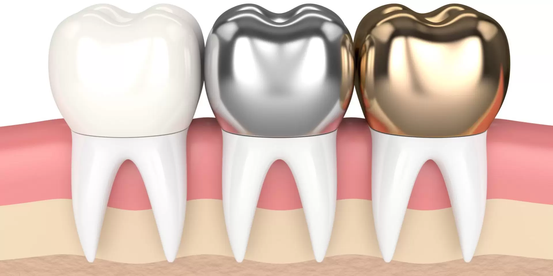 How Long Do Crowns From Turkey Last? 2025–2026 Durability Guide