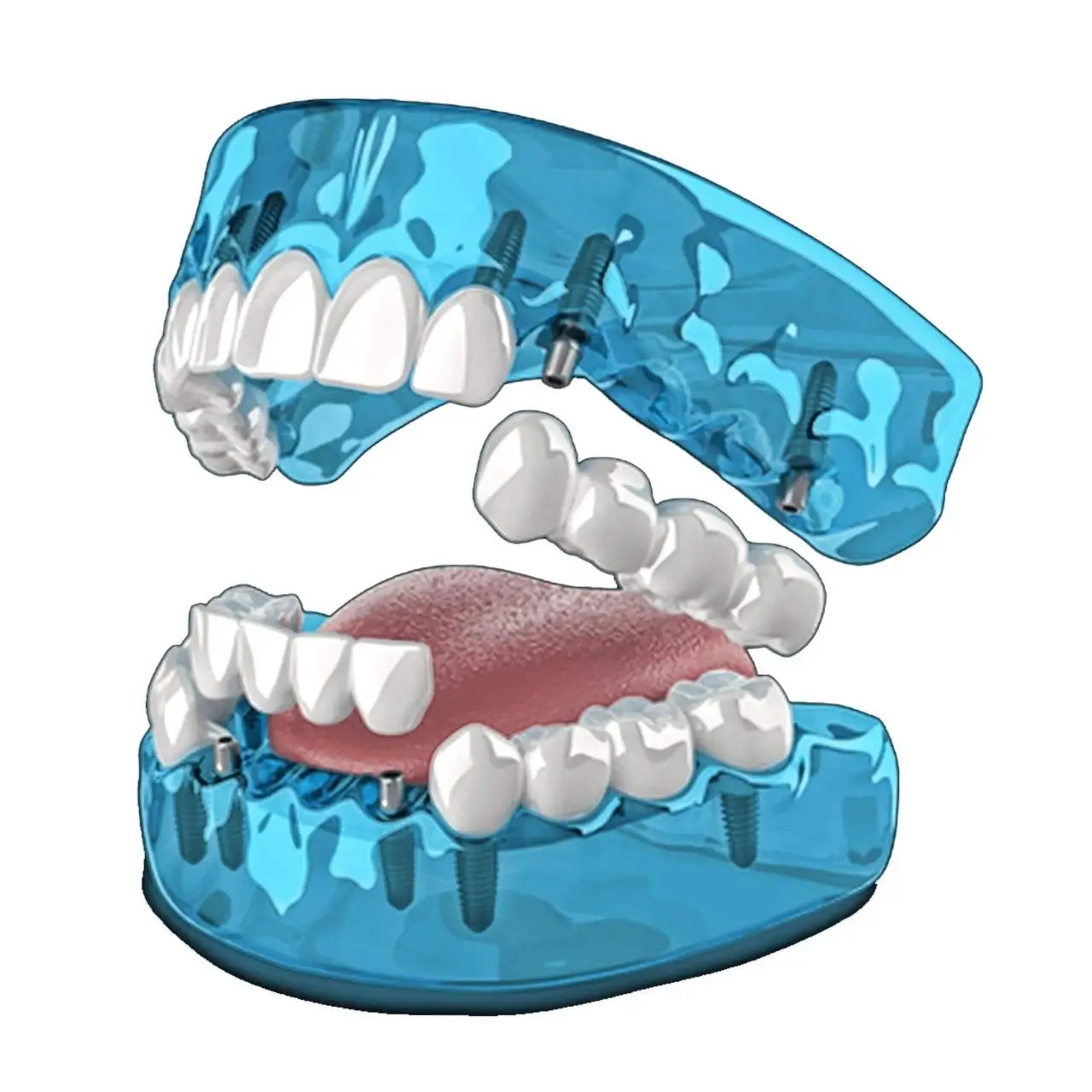 3-on-6 dental implant system at GD Smile Studio in Istanbul