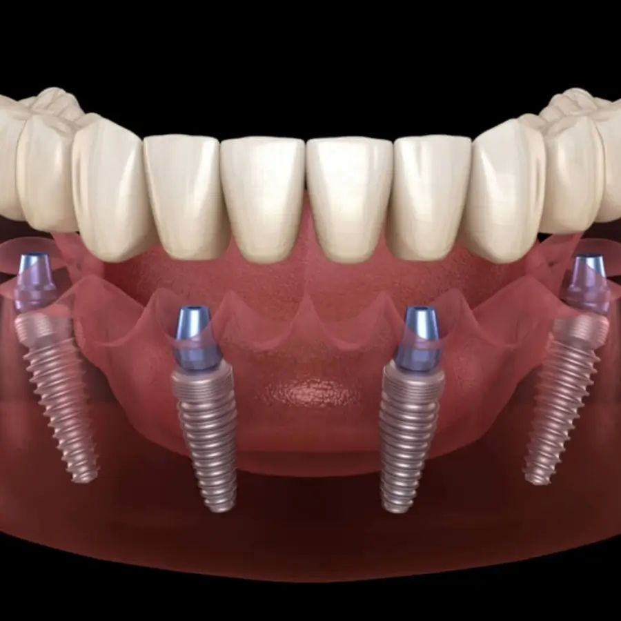 All-on-4 dental implants treatment at GD Smile Studio in Istanbul