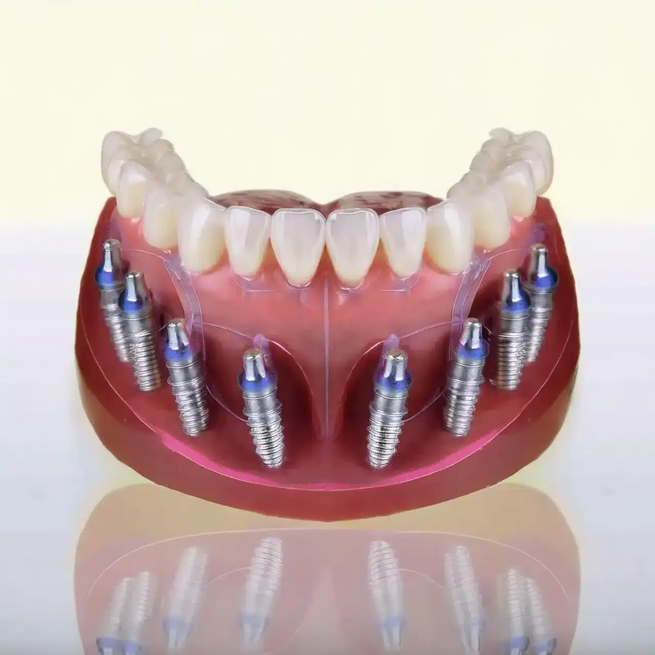 All-on-8 dental implants treatment at GD Smile Studio in Istanbul