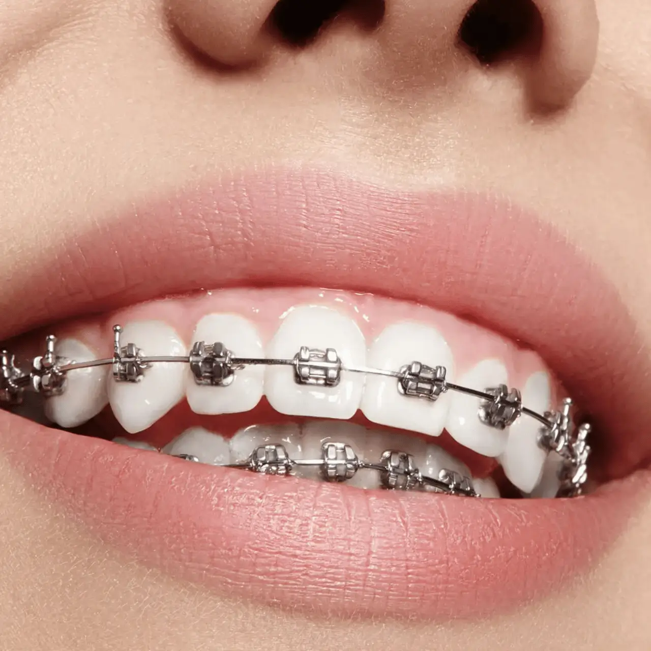 Dental braces at GD Smile Studio in Istanbul