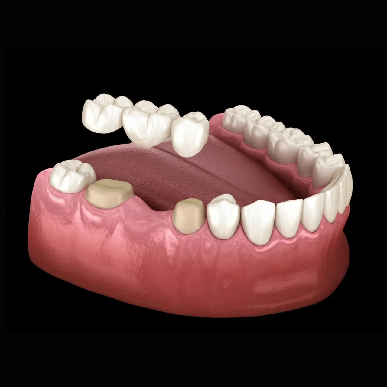 Dental bridges at GD Smile Studio in Istanbul