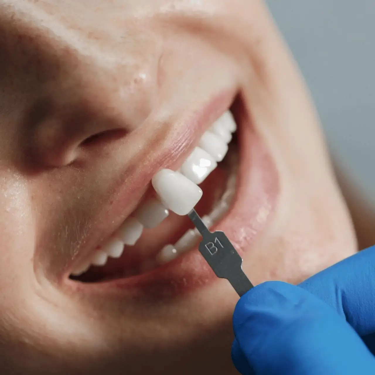 Dental crowns at GD Smile Studio in Istanbul