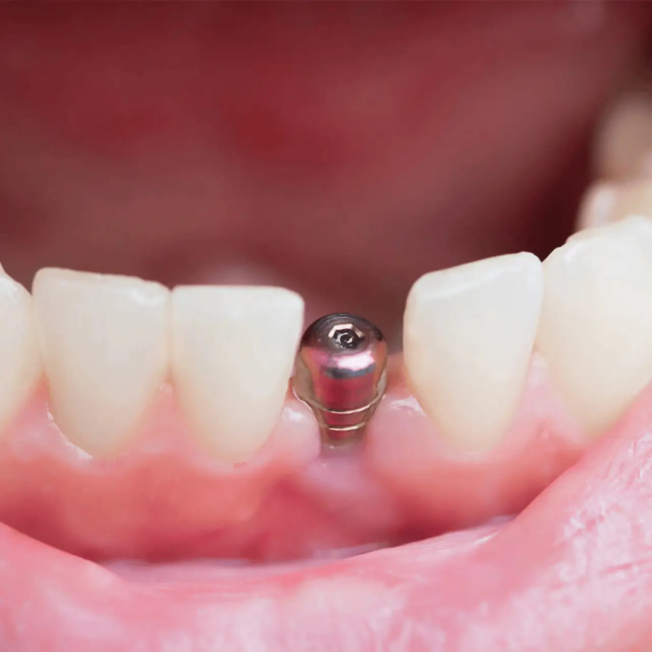 Flapless dental implant treatment at GD Smile Studio in Istanbul