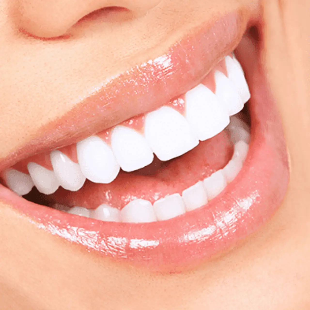 Hollywood Smile makeover at GD Smile Studio in Istanbul