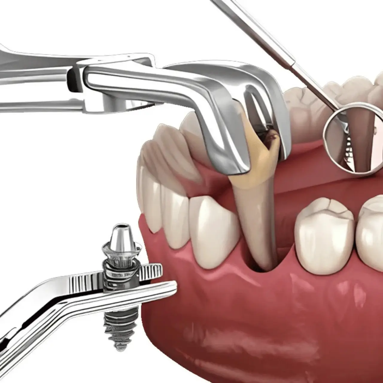 Immediate dental implantation at GD Smile Studio in Istanbul