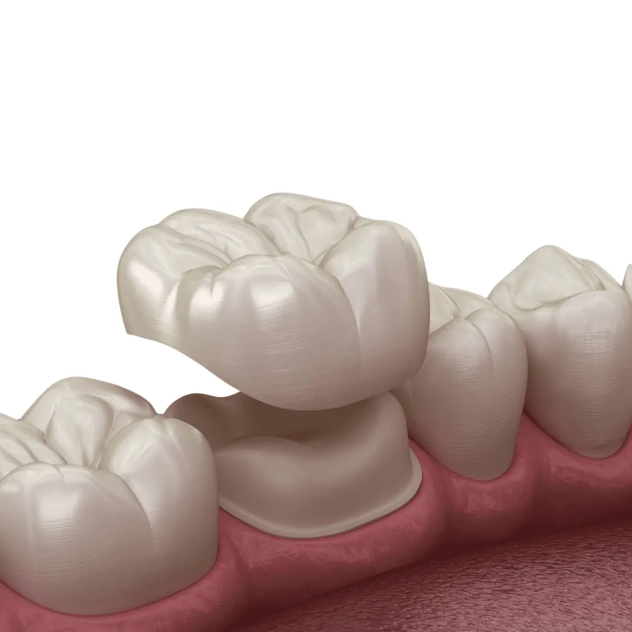 Root canal treatment at GD Smile Studio in Istanbul