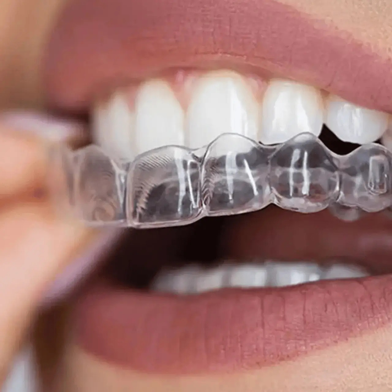 Orthodontic treatment at GD Smile Studio in Istanbul