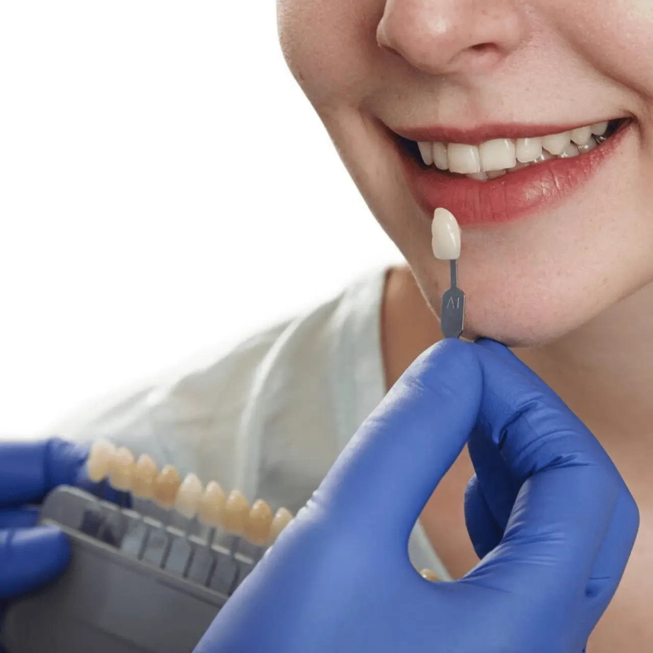 Laminate veneers at GD Smile Studio in Istanbul