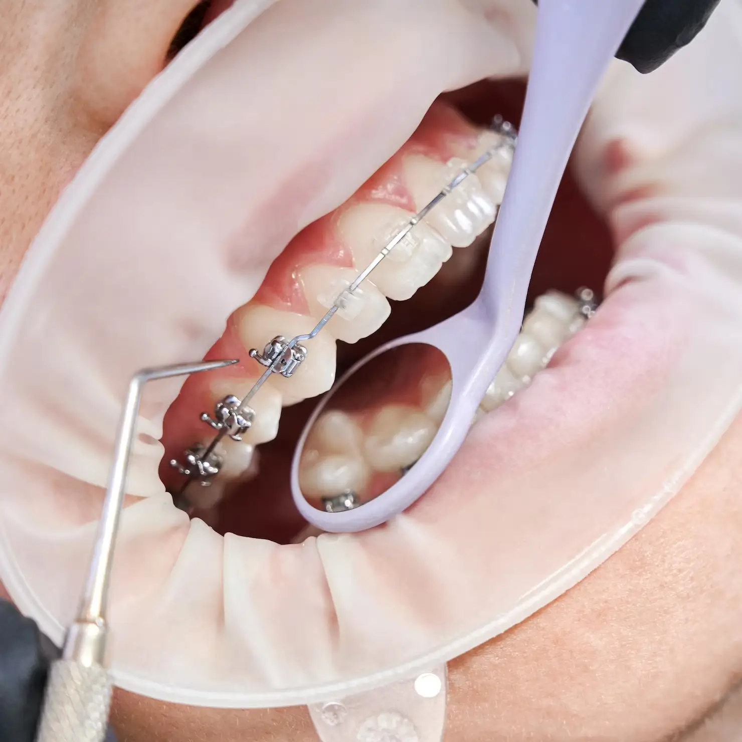 Orthodontic treatment at GD Smile Studio in Istanbul