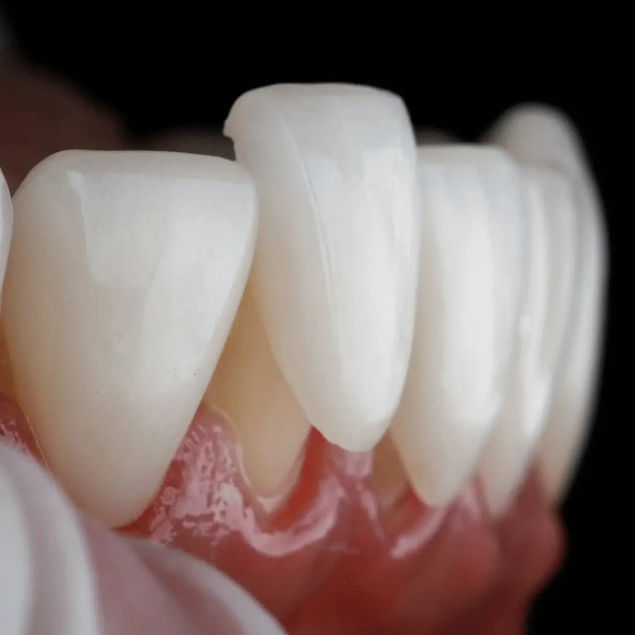 Porcelain veneers at GD Smile Studio in Istanbul