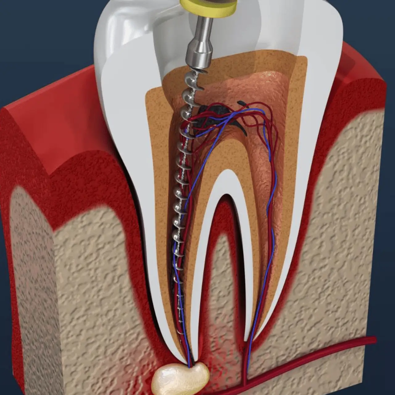 Root canal treatment at GD Smile Studio in Istanbul