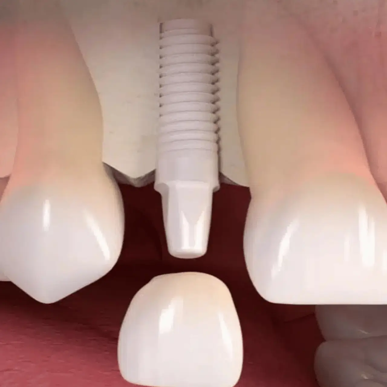 Zirconium dental implants at GD Smile Studio in Istanbul
