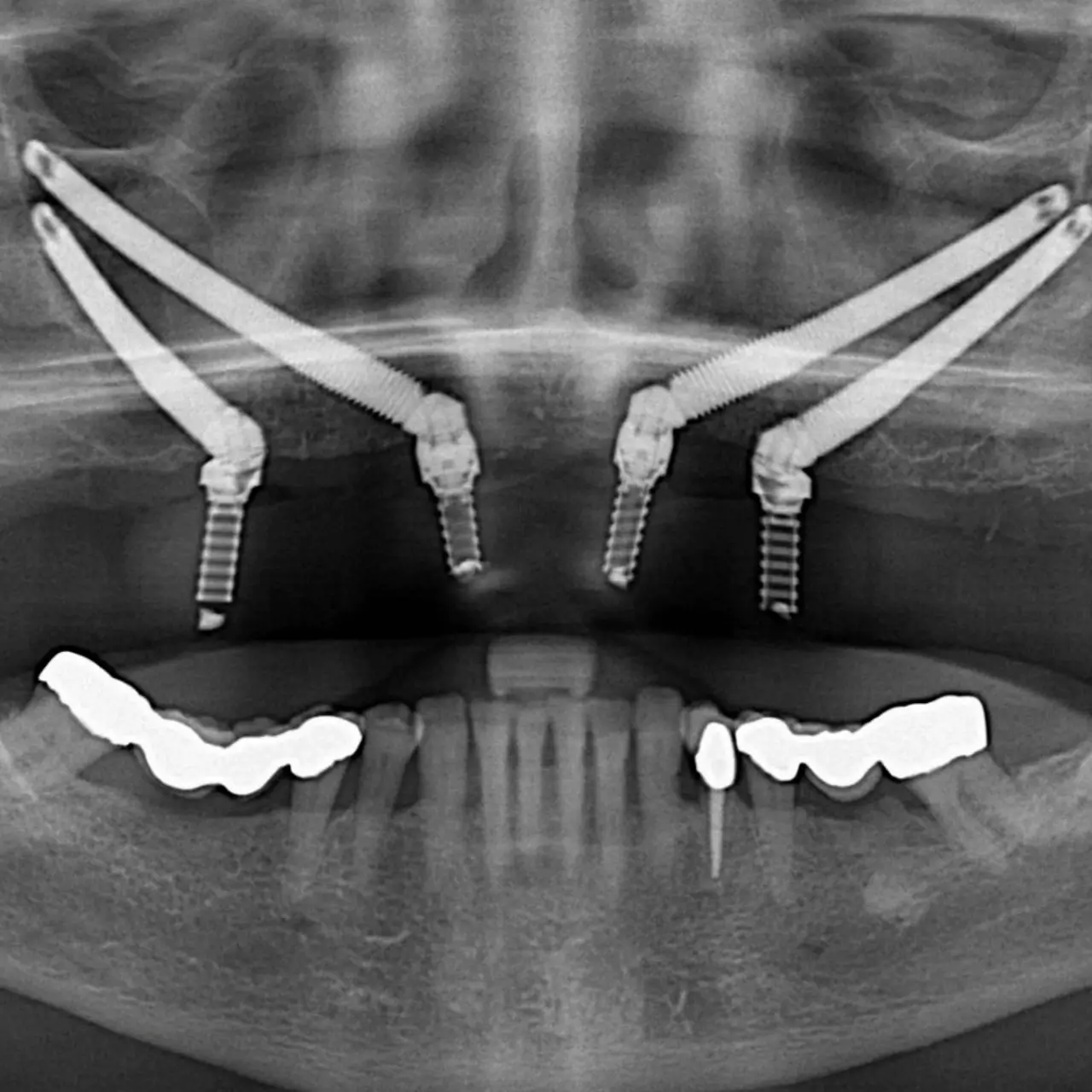 Zygomatic dental implant treatment at GD Smile Studio in Istanbul